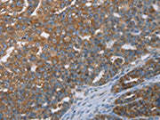 The image on the left is immunohistochemistry of paraffin-embedded Human ovarian cancer tissue using CSB-PA054139(CERS4 Antibody) at dilution 1/35, on the right is treated with synthetic peptide. (Original magnification: ×200)