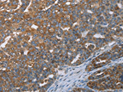 The image on the left is immunohistochemistry of paraffin-embedded Human ovarian cancer tissue using CSB-PA054139(CERS4 Antibody) at dilution 1/35, on the right is treated with synthetic peptide. (Original magnification: ×200)