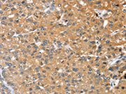 The image on the left is immunohistochemistry of paraffin-embedded Human liver cancer tissue using CSB-PA054201(RASAL1 Antibody) at dilution 1/20, on the right is treated with fusion protein. (Original magnification: ×200)