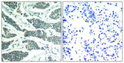 Immunohistochemical analysis of paraffin-embedded human breast carcinoma tissue using AKT1/AKT2/AKT3(Ab-315/316/312) Antibody(left) or the same antibody preincubated with blocking peptide(right).