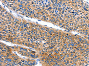The image on the left is immunohistochemistry of paraffin-embedded Human liver cancer tissue using CSB-PA054255(ARL11 Antibody) at dilution 1/50, on the right is treated with fusion protein. (Original magnification: ×200)