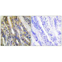 Immunohistochemistry analysis of paraffin-embedded human colon carcinoma tissue, using DGKH antibody.