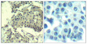 Immunohistochemical analysis of paraffin-embedded human breast carcinoma tissue using mTOR(Ab-2481) Antibody(left) or the same antibody preincubated with blocking peptide(right).