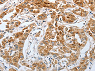 The image on the left is immunohistochemistry of paraffin-embedded Human lung cancer tissue using CSB-PA054695(RTN4 Antibody) at dilution 1/40, on the right is treated with synthetic peptide. (Original magnification: ×200)