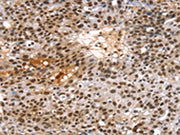 The image on the left is immunohistochemistry of paraffin-embedded Human breast cancer tissue using CSB-PA054836(TAF15 Antibody) at dilution 1/20, on the right is treated with synthetic peptide. (Original magnification: ×200)