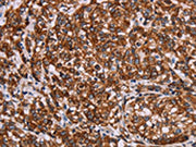 The image on the left is immunohistochemistry of paraffin-embedded Human esophagus cancer tissue using CSB-PA054988(KRT14 Antibody) at dilution 1/20, on the right is treated with synthetic peptide. (Original magnification: ×200)