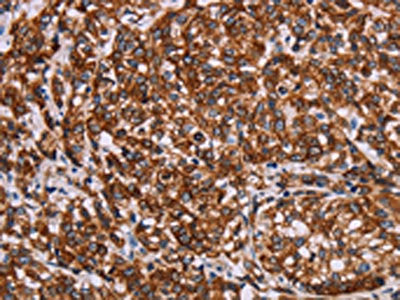 The image on the left is immunohistochemistry of paraffin-embedded Human esophagus cancer tissue using CSB-PA054988(KRT14 Antibody) at dilution 1/20, on the right is treated with synthetic peptide. (Original magnification: ×200)
