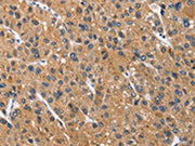 The image on the left is immunohistochemistry of paraffin-embedded Human liver cancer tissue using CSB-PA055165(CEACAM3 Antibody) at dilution 1/70, on the right is treated with fusion protein. (Original magnification: ×200)