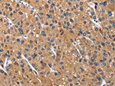 The image on the left is immunohistochemistry of paraffin-embedded Human liver cancer tissue using CSB-PA055165(CEACAM3 Antibody) at dilution 1/70, on the right is treated with fusion protein. (Original magnification: ×200)