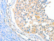 The image on the left is immunohistochemistry of paraffin-embedded Human breast cancer tissue using CSB-PA055199(DUSP14 Antibody) at dilution 1/20, on the right is treated with fusion protein. (Original magnification: ×200)