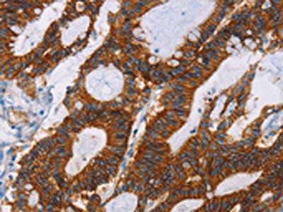 The image on the left is immunohistochemistry of paraffin-embedded Human colon cancer tissue using CSB-PA055320(GPA33 Antibody) at dilution 1/30, on the right is treated with fusion protein. (Original magnification: ×200)