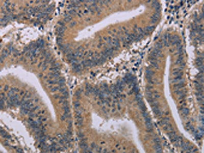 The image on the left is immunohistochemistry of paraffin-embedded Human colon cancer tissue using CSB-PA055681(ACVR2A Antibody) at dilution 1/20, on the right is treated with synthetic peptide. (Original magnification: ×200)