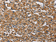 The image on the left is immunohistochemistry of paraffin-embedded Human thyroid cancer tissue using CSB-PA055744(BMP15 Antibody) at dilution 1/40, on the right is treated with fusion protein. (Original magnification: ×200)