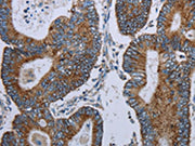 The image on the left is immunohistochemistry of paraffin-embedded Human colon cancer tissue using CSB-PA055799(ELAVL3 Antibody) at dilution 1/20, on the right is treated with synthetic peptide. (Original magnification: ×200)