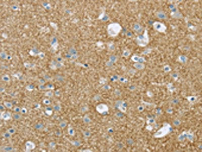The image on the left is immunohistochemistry of paraffin-embedded Human brain tissue using CSB-PA055935(VAMP2 Antibody) at dilution 1/20, on the right is treated with synthetic peptide. (Original magnification: ×200)