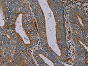 The image on the left is immunohistochemistry of paraffin-embedded Human colon cancer tissue using CSB-PA056057(PYY Antibody) at dilution 1/40, on the right is treated with synthetic peptide. (Original magnification: ×200)