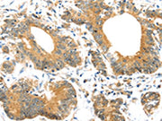 The image on the left is immunohistochemistry of paraffin-embedded Human colorectal cancer tissue using CSB-PA056268(UBTD1 Antibody) at dilution 1/30, on the right is treated with synthetic peptide. (Original magnification: ×200)
