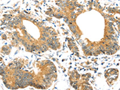 The image on the left is immunohistochemistry of paraffin-embedded Human colorectal cancer tissue using CSB-PA056268(UBTD1 Antibody) at dilution 1/30, on the right is treated with synthetic peptide. (Original magnification: ×200)