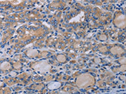 The image on the left is immunohistochemistry of paraffin-embedded Human thyroid cancer tissue using CSB-PA056352(P2RX3 Antibody) at dilution 1/50, on the right is treated with synthetic peptide. (Original magnification: ×200)
