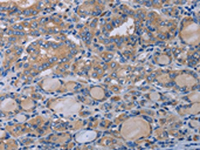 The image on the left is immunohistochemistry of paraffin-embedded Human thyroid cancer tissue using CSB-PA056352(P2RX3 Antibody) at dilution 1/50, on the right is treated with synthetic peptide. (Original magnification: ×200)