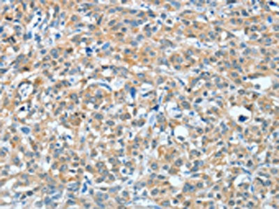 The image on the left is immunohistochemistry of paraffin-embedded Human esophagus cancer tissue using CSB-PA056537(BAG3 Antibody) at dilution 1/20, on the right is treated with fusion protein. (Original magnification: ×200)