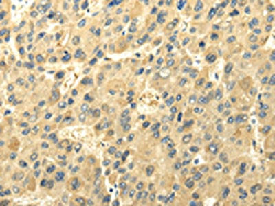 The image on the left is immunohistochemistry of paraffin-embedded Human liver cancer tissue using CSB-PA056617(UGT1A6 Antibody) at dilution 1/35, on the right is treated with synthetic peptide. (Original magnification: ×200)