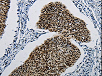 The image on the left is immunohistochemistry of paraffin-embedded Human cervical cancer tissue using CSB-PA056628(DDB1 Antibody) at dilution 1/5, on the right is treated with synthetic peptide. (Original magnification: ×200)