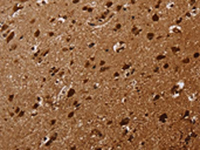 The image on the left is immunohistochemistry of paraffin-embedded Human brain tissue using CSB-PA056745(KARS Antibody) at dilution 1/30, on the right is treated with fusion protein. (Original magnification: ×200)