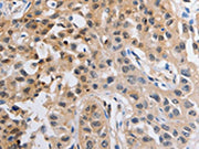 The image on the left is immunohistochemistry of paraffin-embedded Human lung cancer tissue using CSB-PA056855(NCK1 Antibody) at dilution 1/20, on the right is treated with fusion protein. (Original magnification: x200)