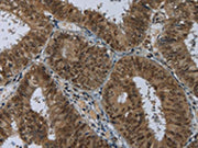 The image on the left is immunohistochemistry of paraffin-embedded Human colon cancer tissue using CSB-PA056873(MRE11A Antibody) at dilution 1/60, on the right is treated with fusion protein. (Original magnification: ×200)