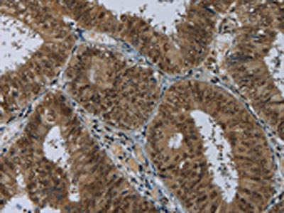 The image on the left is immunohistochemistry of paraffin-embedded Human colon cancer tissue using CSB-PA056873(MRE11A Antibody) at dilution 1/60, on the right is treated with fusion protein. (Original magnification: ×200)