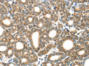 The image on the left is immunohistochemistry of paraffin-embedded Human thyroid cancer tissue using CSB-PA057029(GZMK Antibody) at dilution 1/20, on the right is treated with synthetic peptide. (Original magnification: ×200)