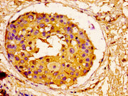 IHC image of CSB-PA05709A0Rb diluted at 1:100 and staining in paraffin-embedded human breast cancer performed on a Leica BondTM system. After dewaxing and hydration, antigen retrieval was mediated by high pressure in a citrate buffer (pH 6.0). Sec...