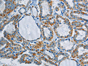 The image on the left is immunohistochemistry of paraffin-embedded Human thyroid cancer tissue using CSB-PA057249(PPARGC1B Antibody) at dilution 1/40, on the right is treated with synthetic peptide. (Original magnification: ×200)
