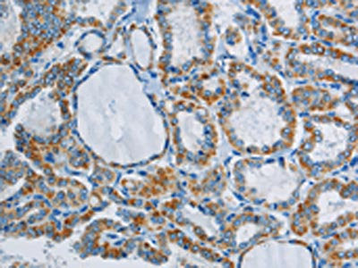 The image on the left is immunohistochemistry of paraffin-embedded Human thyroid cancer tissue using CSB-PA057249(PPARGC1B Antibody) at dilution 1/40, on the right is treated with synthetic peptide. (Original magnification: ×200)