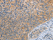 The image on the left is immunohistochemistry of paraffin-embedded Human cervical cancer tissue using CSB-PA057264(SPIRE2 Antibody) at dilution 1/30, on the right is treated with fusion protein. (Original magnification: ×200)