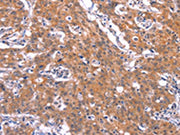 The image on the left is immunohistochemistry of paraffin-embedded Human gastic cancer tissue using CSB-PA057490(TNFRSF17 Antibody) at dilution 1/30, on the right is treated with synthetic peptide. (Original magnification: ×200)