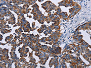The image on the left is immunohistochemistry of paraffin-embedded Human ovarian cancer tissue using CSB-PA057546(TRIM13 Antibody) at dilution 1/30, on the right is treated with fusion protein. (Original magnification: ×200)