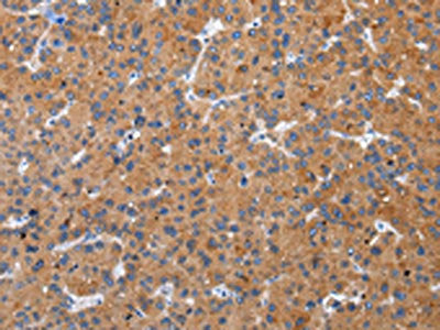 The image on the left is immunohistochemistry of paraffin-embedded Human liver cancer tissue using CSB-PA057570(ZFAND2A Antibody) at dilution 1/30, on the right is treated with synthetic peptide. (Original magnification: ×200)