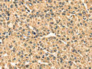 The image on the left is immunohistochemistry of paraffin-embedded Human liver cancer tissue using CSB-PA057670(TMPRSS3 Antibody) at dilution 1/35, on the right is treated with synthetic peptide. (Original magnification: ×200)
