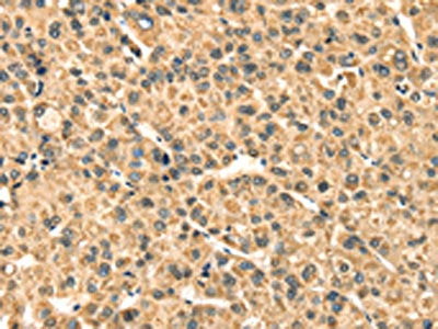 The image on the left is immunohistochemistry of paraffin-embedded Human liver cancer tissue using CSB-PA057670(TMPRSS3 Antibody) at dilution 1/35, on the right is treated with synthetic peptide. (Original magnification: ×200)