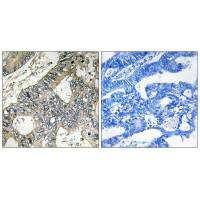Immunohistochemistry analysis of paraffin-embedded human colon carcinoma tissue using GUF1 antibody.
