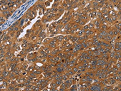 The image on the left is immunohistochemistry of paraffin-embedded Human ovarian cancer tissue using CSB-PA057722(ADAMTS15 Antibody) at dilution 1/40, on the right is treated with fusion protein. (Original magnification: ×200)