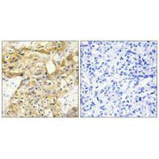 Immunohistochemistry analysis of paraffin-embedded human liver carcinoma tissue using Collagen XVIII α1 antibody.