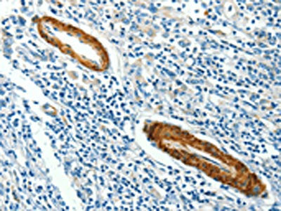 The image on the left is immunohistochemistry of paraffin-embedded Human gastic cancer tissue using CSB-PA057927(CAV3 Antibody) at dilution 1/40, on the right is treated with synthetic peptide. (Original magnification: ×200)