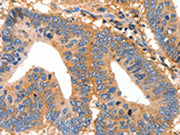 The image on the left is immunohistochemistry of paraffin-embedded Human colon cancer tissue using CSB-PA058161(MUC6 Antibody) at dilution 1/25, on the right is treated with synthetic peptide. (Original magnification: ×200)