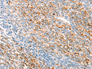 The image on the left is immunohistochemistry of paraffin-embedded Human ovarian cancer tissue using CSB-PA058340(THY1 Antibody) at dilution 1/25, on the right is treated with synthetic peptide. (Original magnification: ×200)