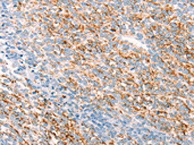 The image on the left is immunohistochemistry of paraffin-embedded Human ovarian cancer tissue using CSB-PA058340(THY1 Antibody) at dilution 1/25, on the right is treated with synthetic peptide. (Original magnification: ×200)