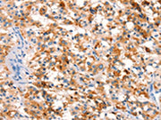 The image on the left is immunohistochemistry of paraffin-embedded Human thyroid cancer tissue using CSB-PA058370(SPRN Antibody) at dilution 1/15, on the right is treated with synthetic peptide. (Original magnification: ×200)