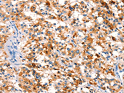 The image on the left is immunohistochemistry of paraffin-embedded Human thyroid cancer tissue using CSB-PA058370(SPRN Antibody) at dilution 1/15, on the right is treated with synthetic peptide. (Original magnification: ×200)
